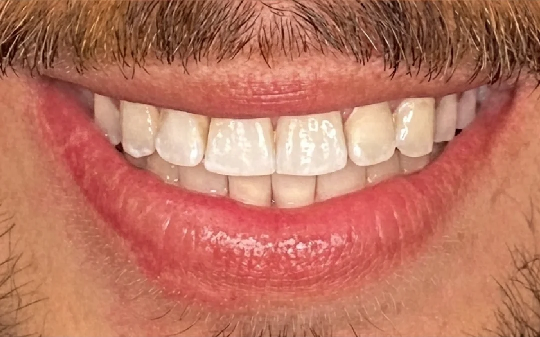 Case 1 patient's smile after dental treatment at Sunshine Smiles Dental Clinic, showing improved teeth