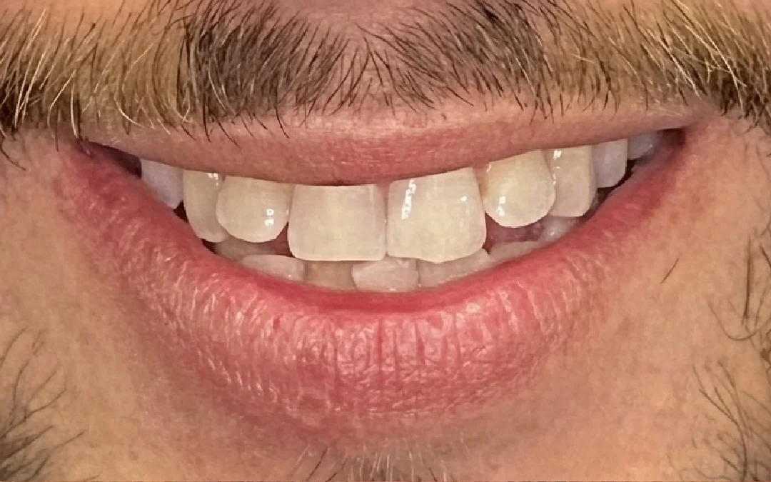 Case 1 patient's smile before dental treatment at Sunshine Smiles Dental Clinic
