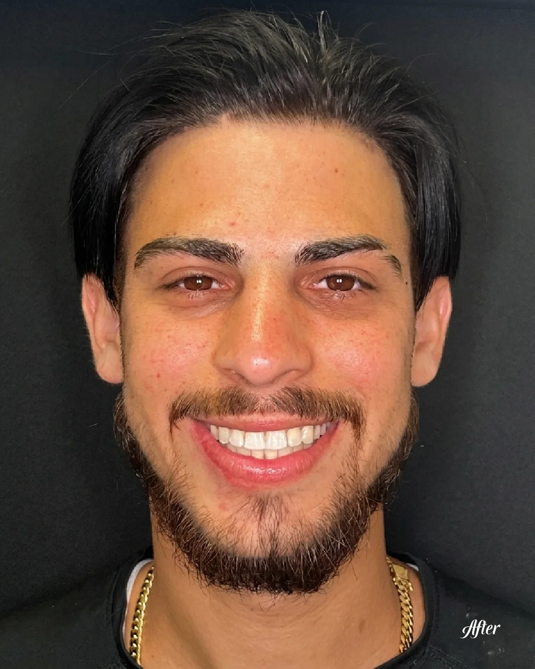Patient's bright, natural-looking smile after completing dental treatment at Sunshine Smiles