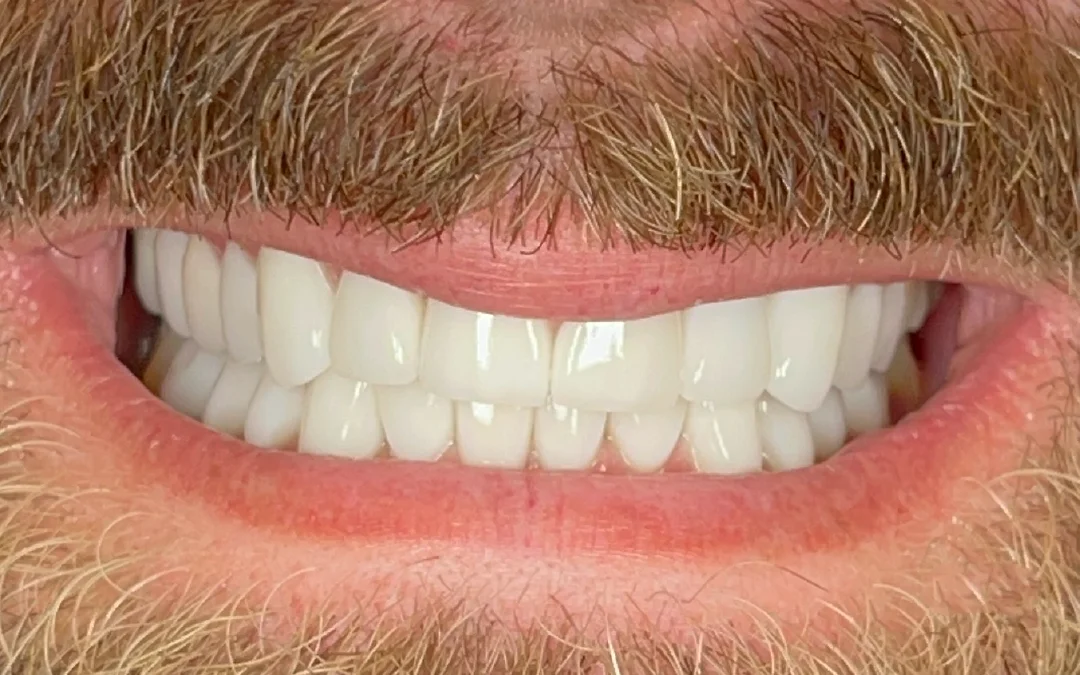 Case 2 patient's smile after dental treatment at Sunshine Smiles Dental Clinic, showing improved teeth