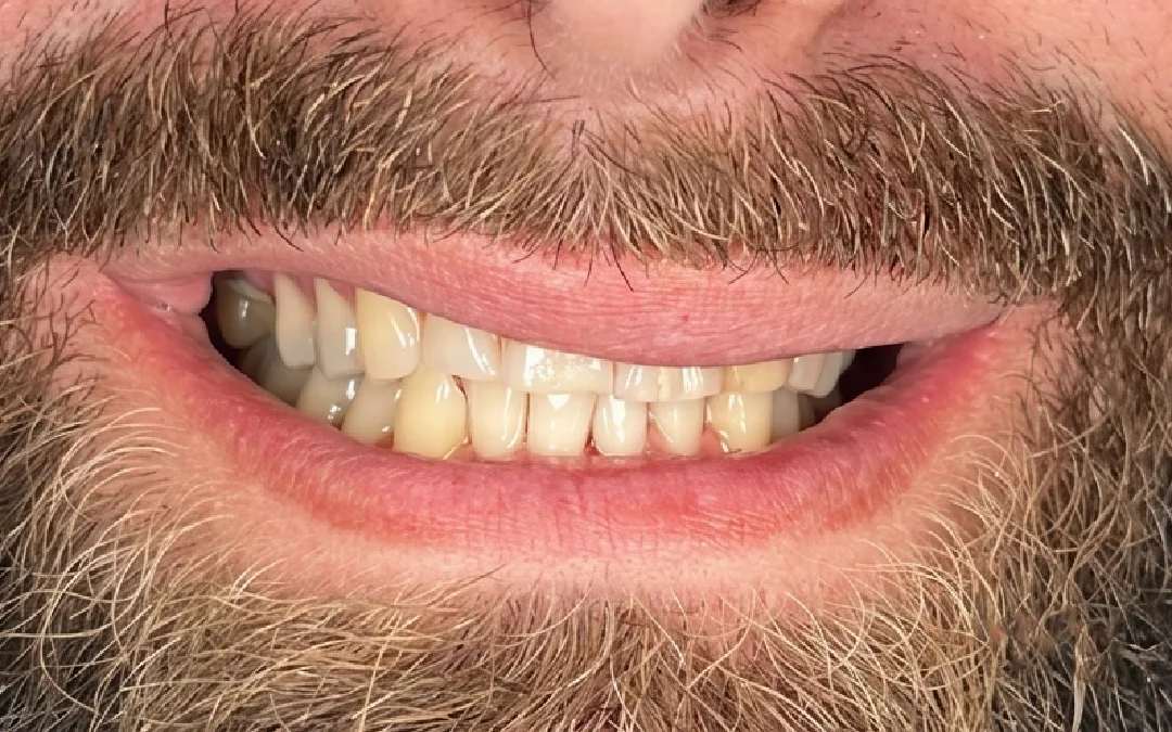 Case 2 patient's smile before dental treatment at Sunshine Smiles Dental Clinic