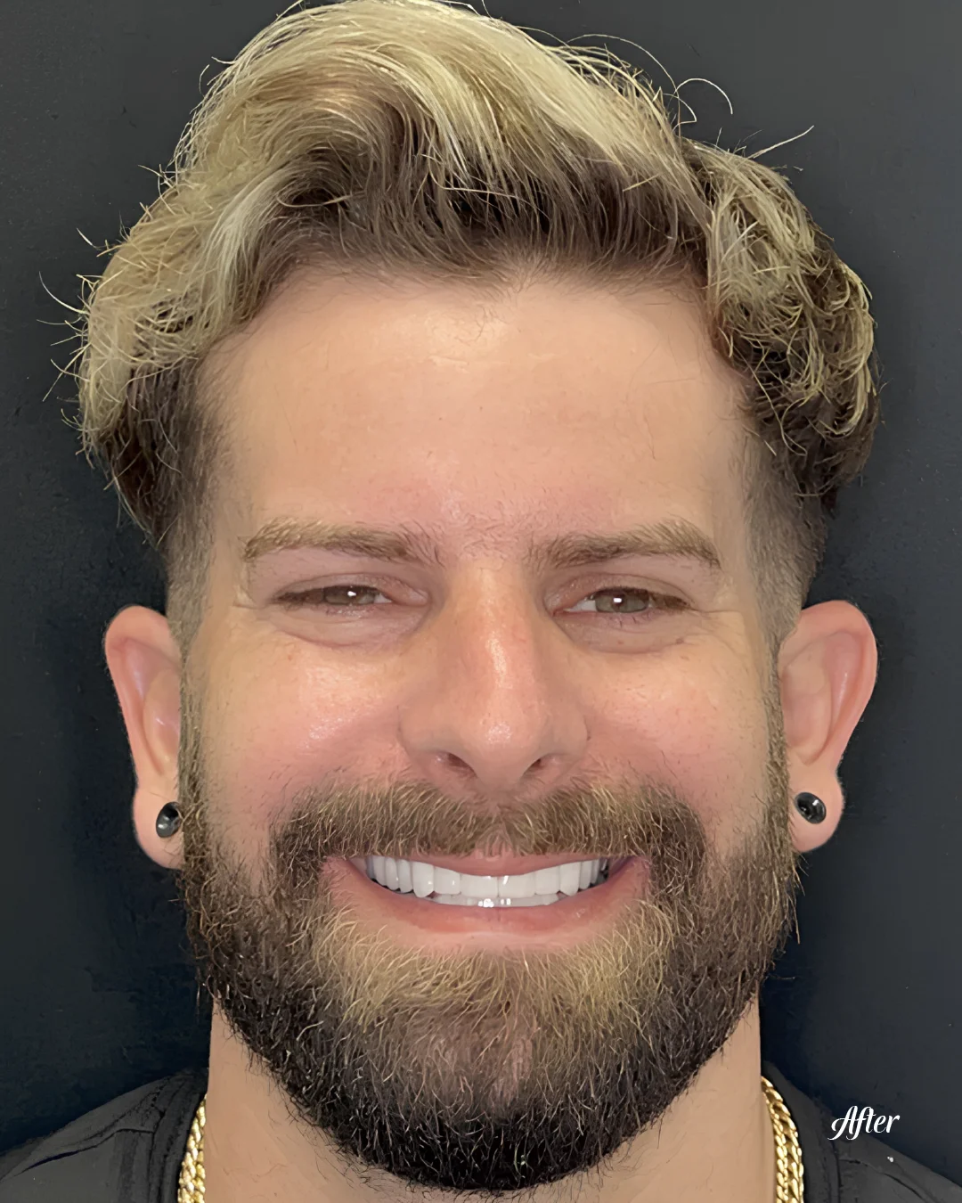 Close-up of a patient's even, white smile following cosmetic dental work