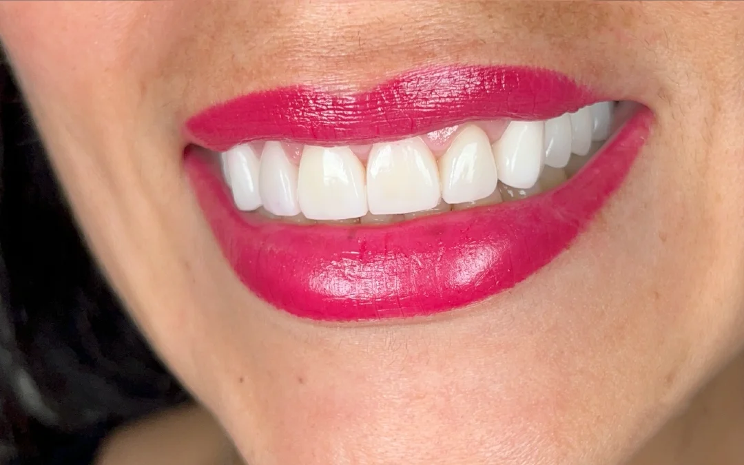 Case 3 patient's smile after dental treatment at Sunshine Smiles Dental Clinic, showing improved teeth