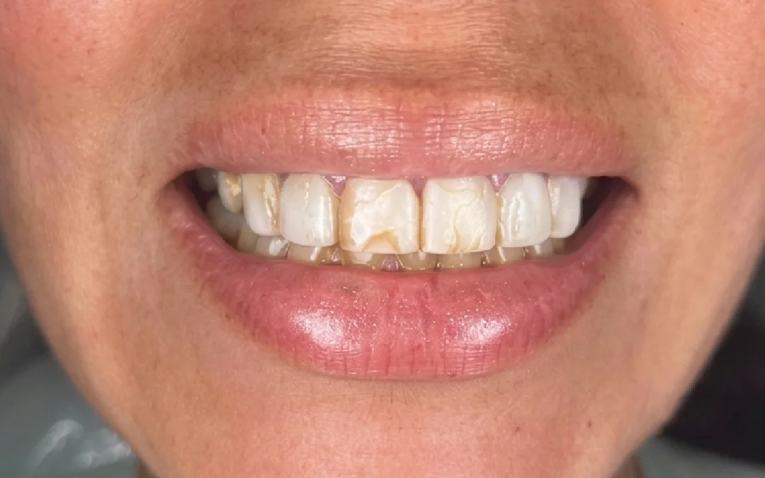 Case 3 patient's smile before dental treatment at Sunshine Smiles Dental Clinic