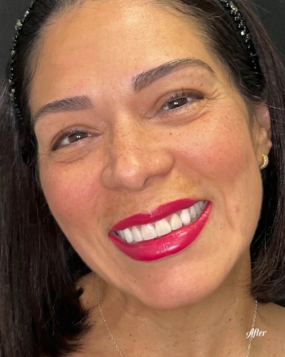 Smiling patient showing restored front teeth after treatment