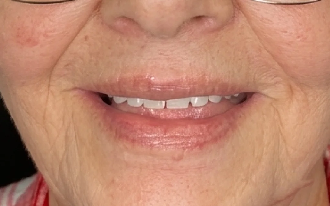 Case 4 patient's smile after dental treatment at Sunshine Smiles Dental Clinic, showing improved teeth
