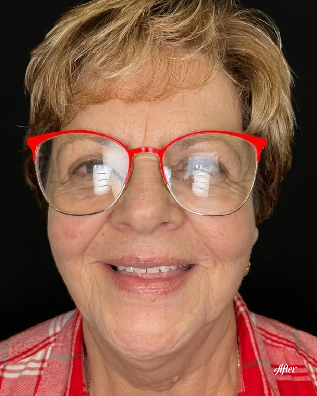 Patient's transformed after-treatment smile at Sunshine Smiles Dental Clinic