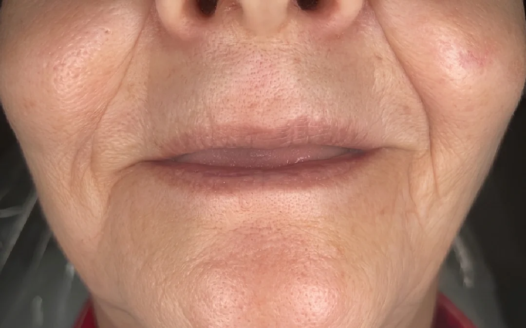 Case 4 patient's smile before dental treatment at Sunshine Smiles Dental Clinic