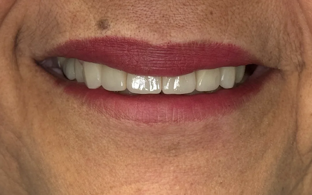 Case 5 patient's smile after dental treatment at Sunshine Smiles Dental Clinic, showing improved teeth