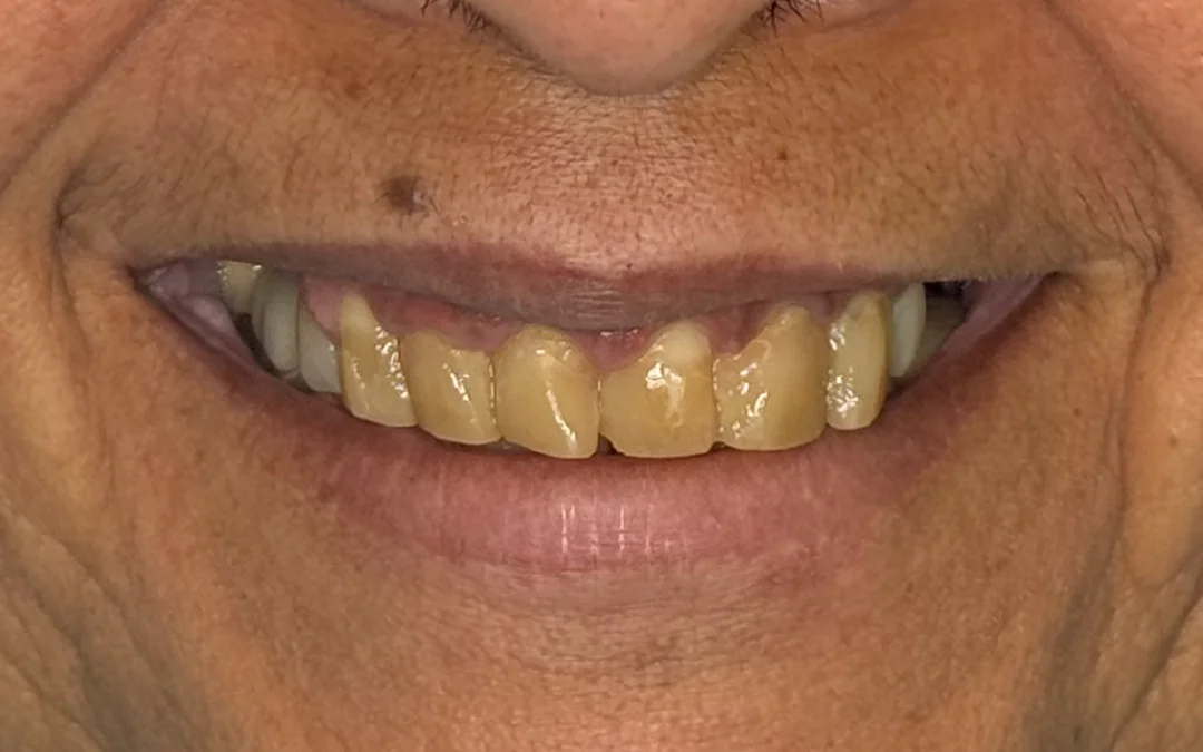 Case 5 patient's smile before dental treatment at Sunshine Smiles Dental Clinic