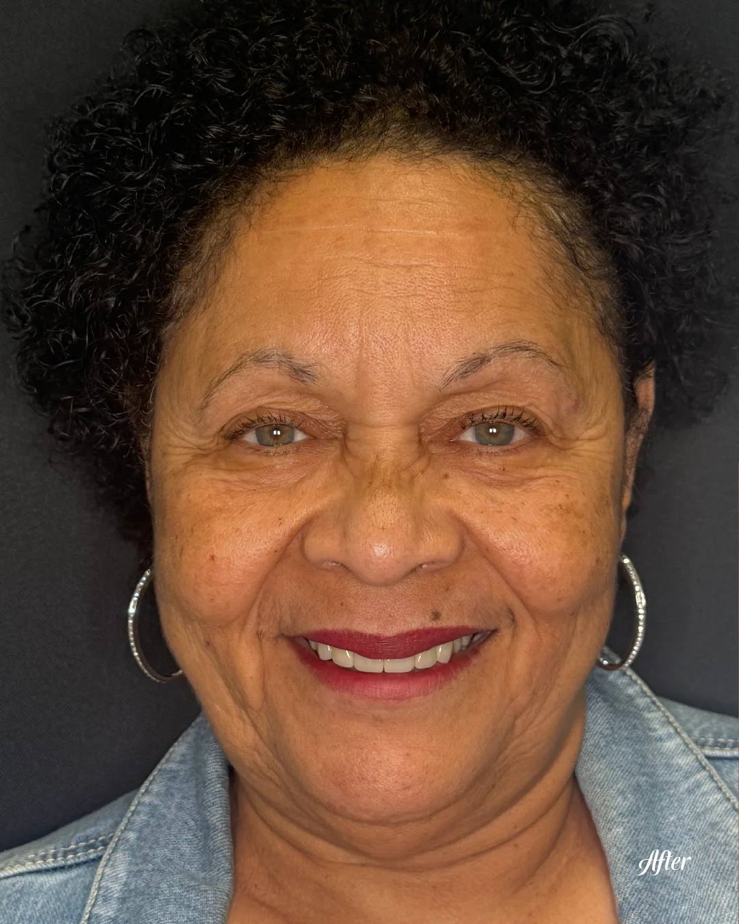 Patient's confident smile after a full smile makeover