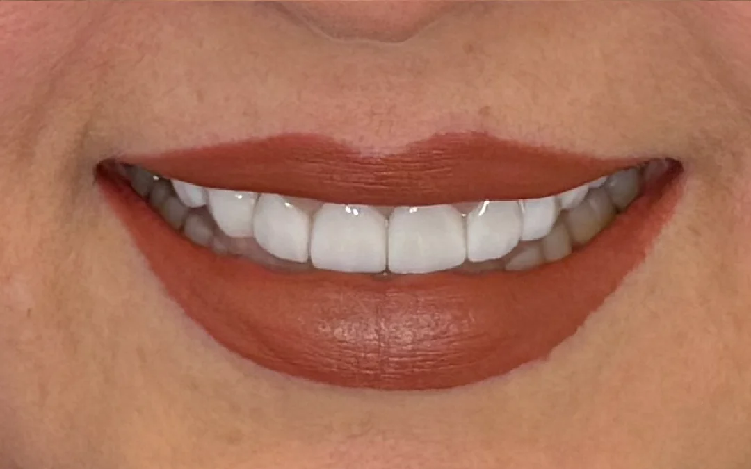 Case 6 patient's smile after dental treatment at Sunshine Smiles Dental Clinic, showing improved teeth