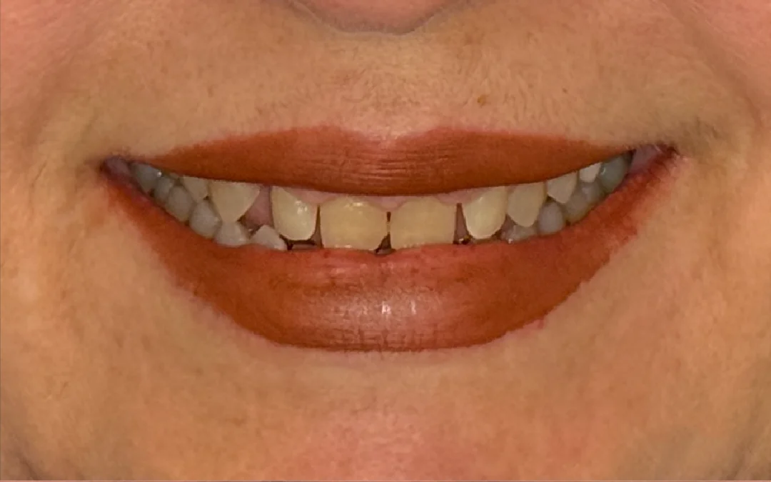 Case 6 patient's smile before dental treatment at Sunshine Smiles Dental Clinic