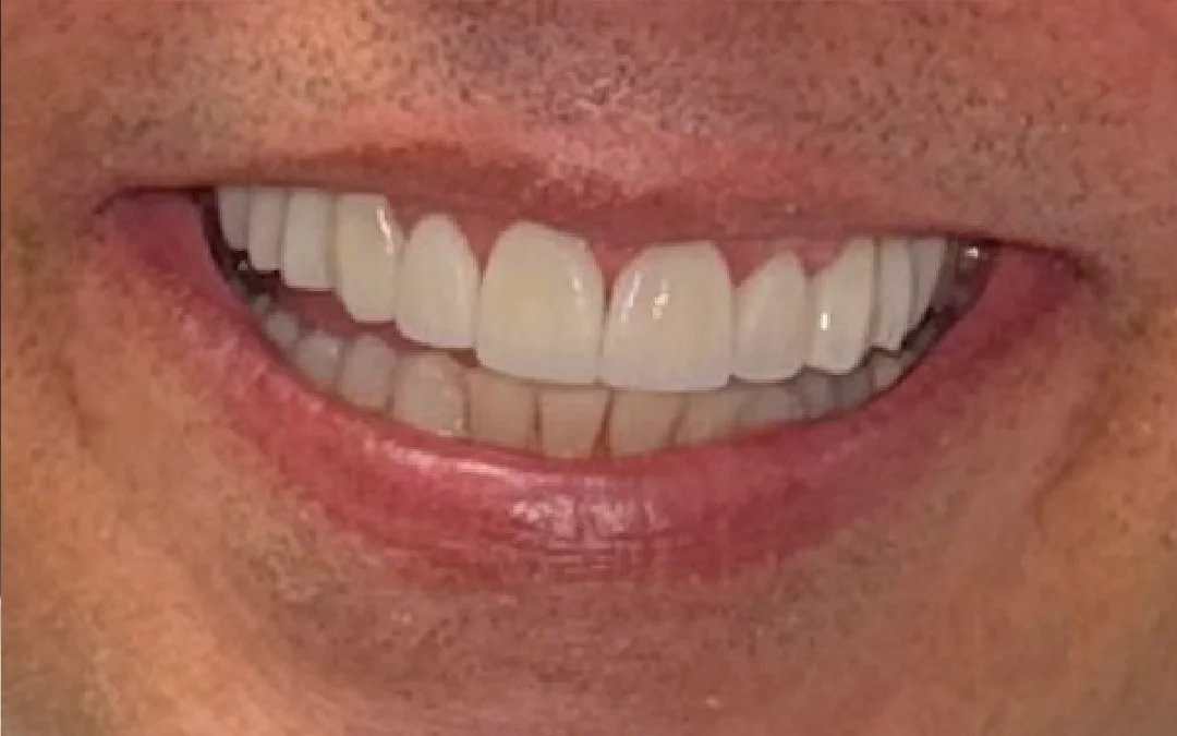 Case 7 patient's smile after dental treatment at Sunshine Smiles Dental Clinic, showing improved teeth