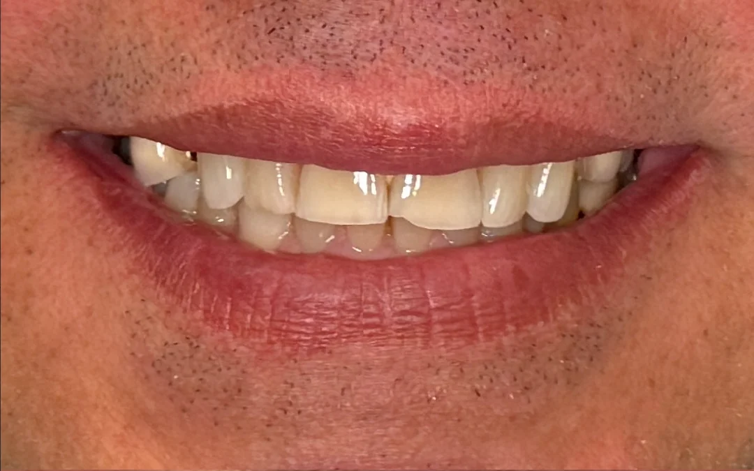 Case 7 patient's smile before dental treatment at Sunshine Smiles Dental Clinic