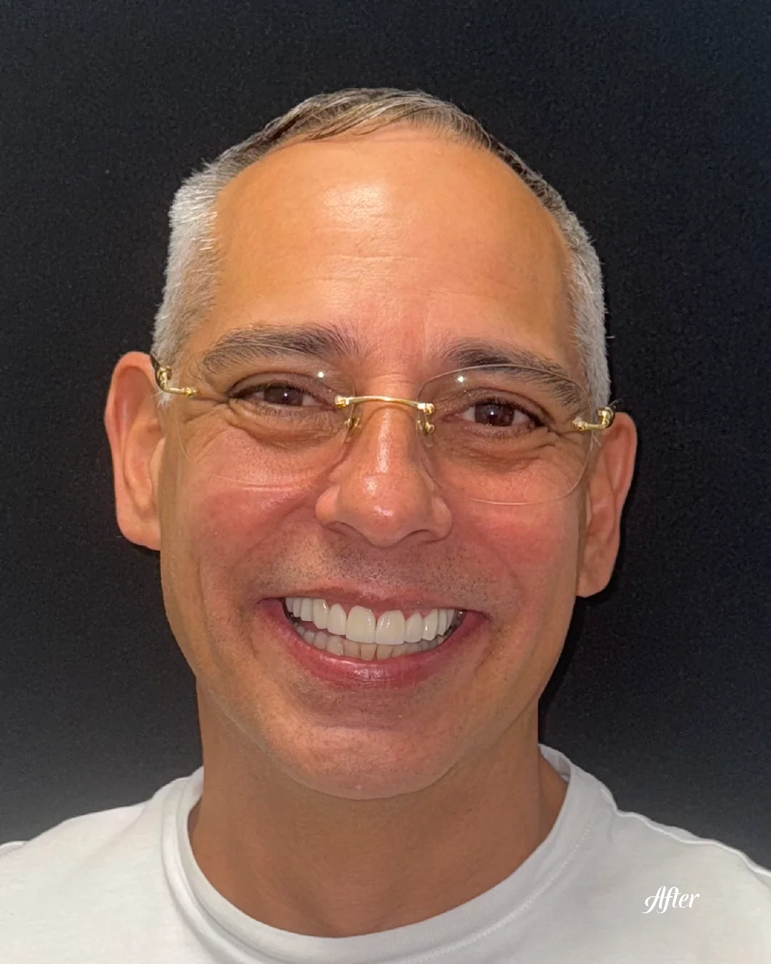Patient's straightened, brightened smile after treatment