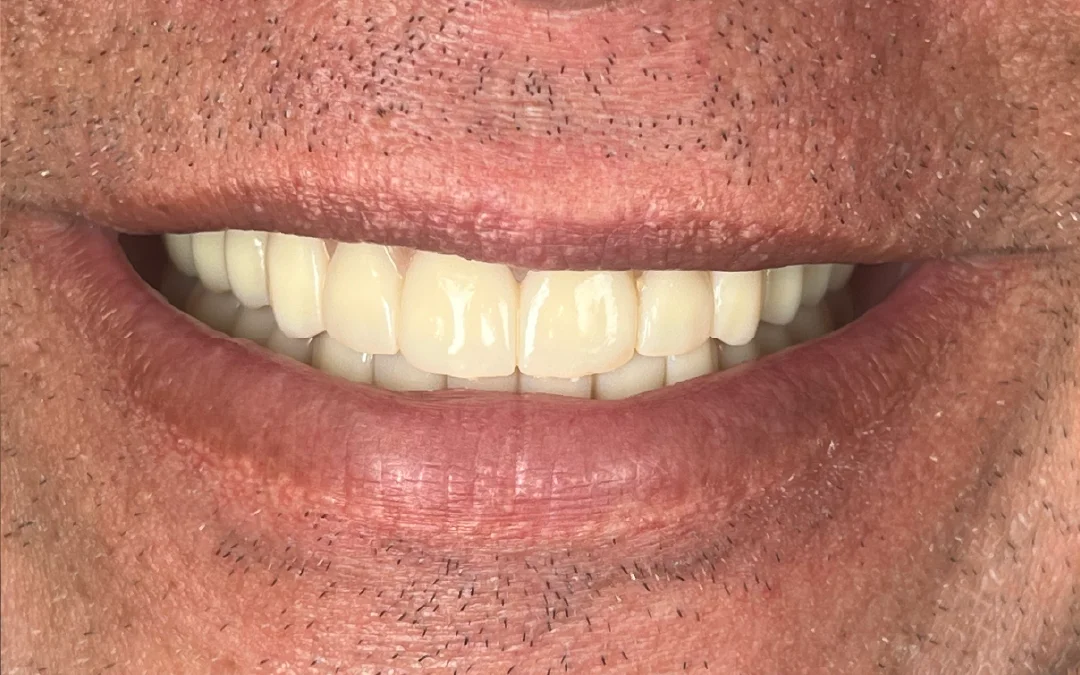 Case 8 patient's smile after dental treatment at Sunshine Smiles Dental Clinic, showing improved teeth