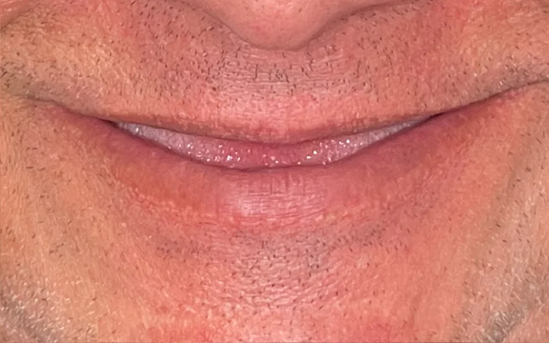 Case 8 patient's smile before dental treatment at Sunshine Smiles Dental Clinic