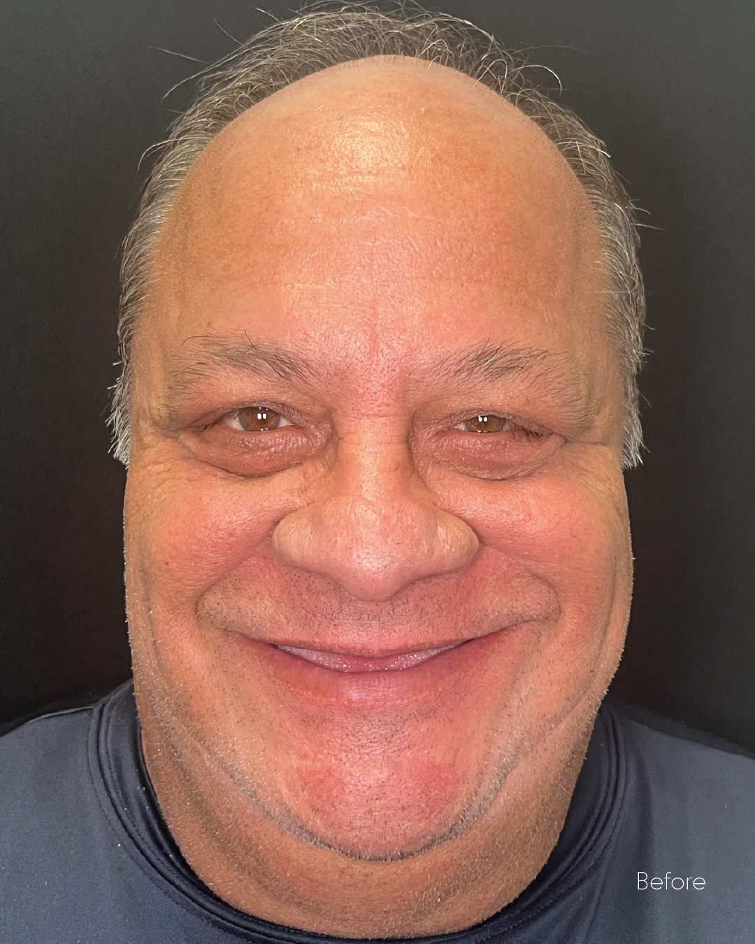 Patient smiling with a renewed, uniform set of teeth after dental work